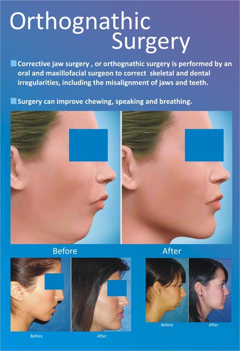 immediate dental implants